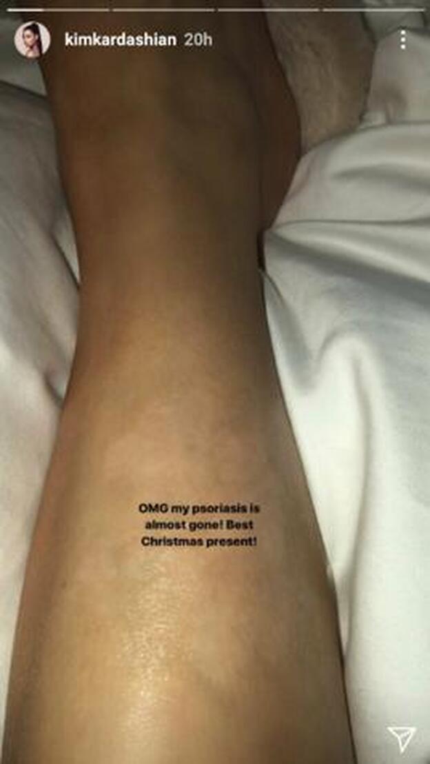 Kim Kardashian muestra su recuperación en la zona afectada por psoriasis.