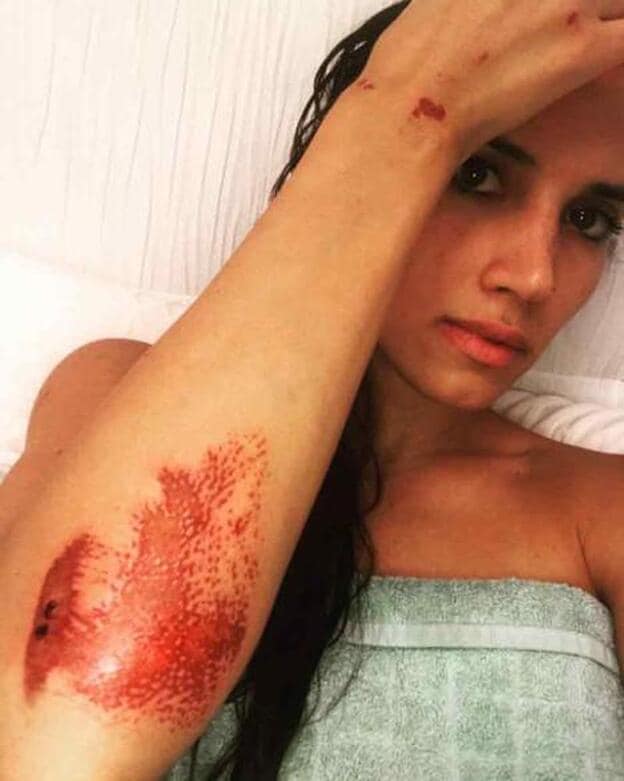India Martínez muestra cómo evoluciona la herida de su brazo./instagram.